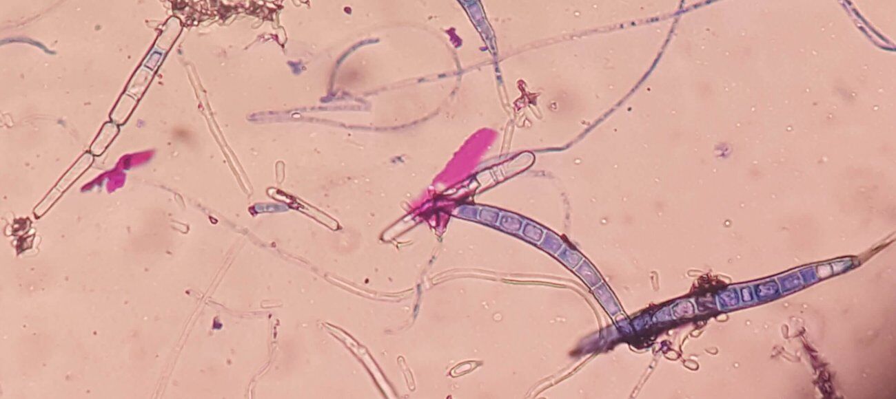 Trichophyton mentagrophytes and Antifungal Treatments